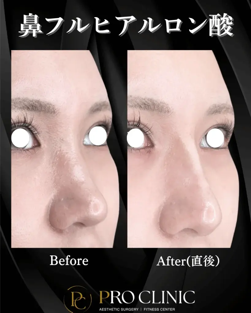 プロクリニック ヒアルロン酸 鼻フル