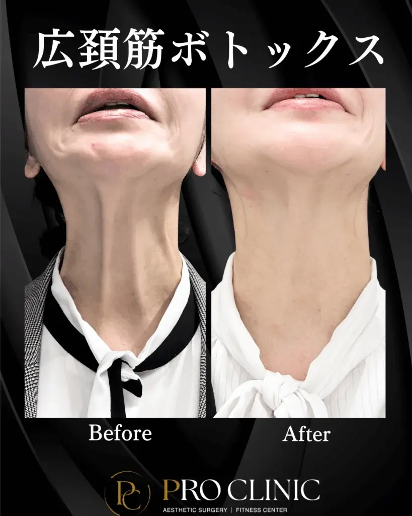 プロクリニック　広頚筋ボトックス　ボトックス