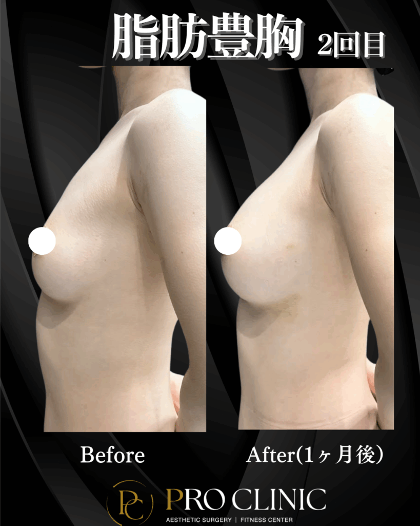 プロクリニック　脂肪豊胸　脂肪　豊胸