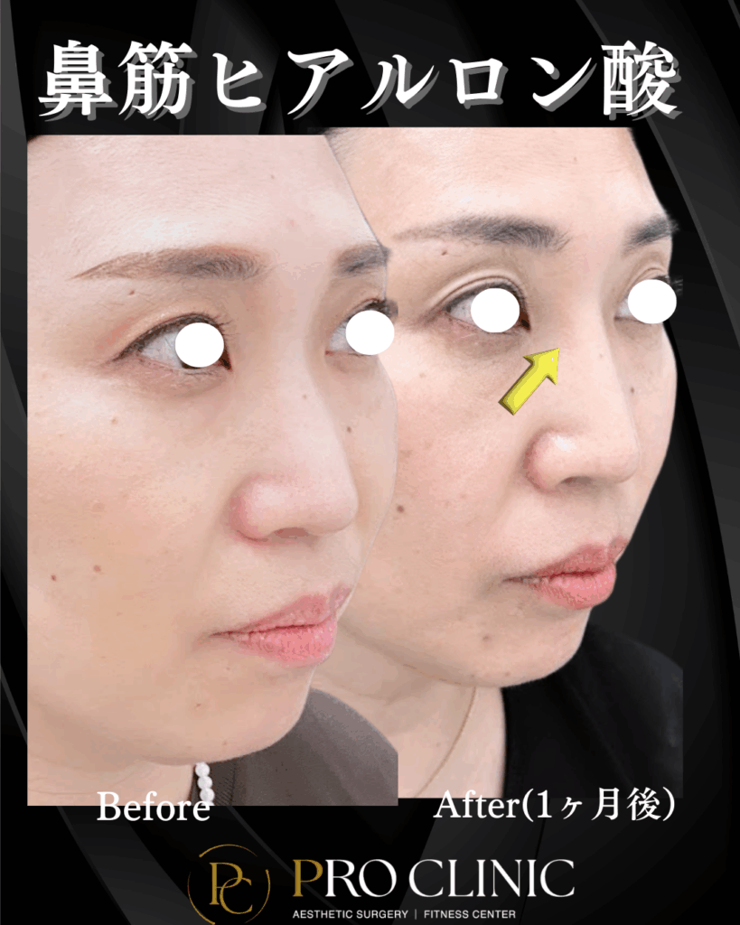 プロクリニック　ヒアルロン酸　鼻フル