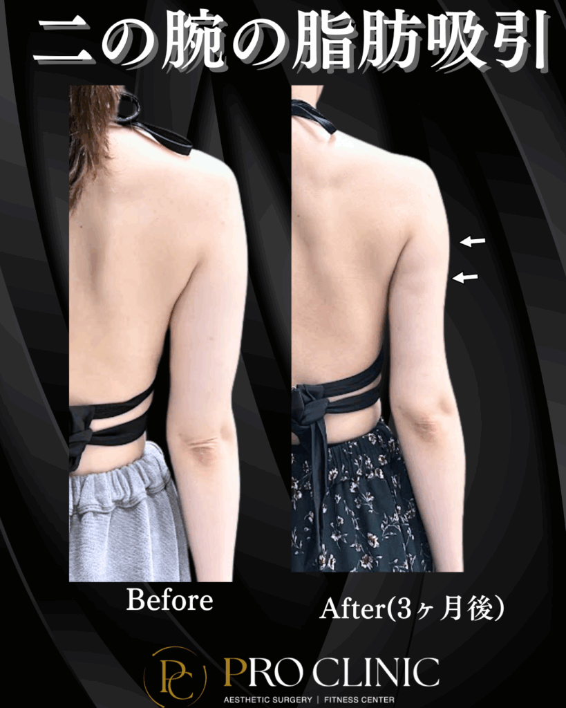 プロクリニック　二の腕の脂肪吸引　脂肪吸引　振袖　後面