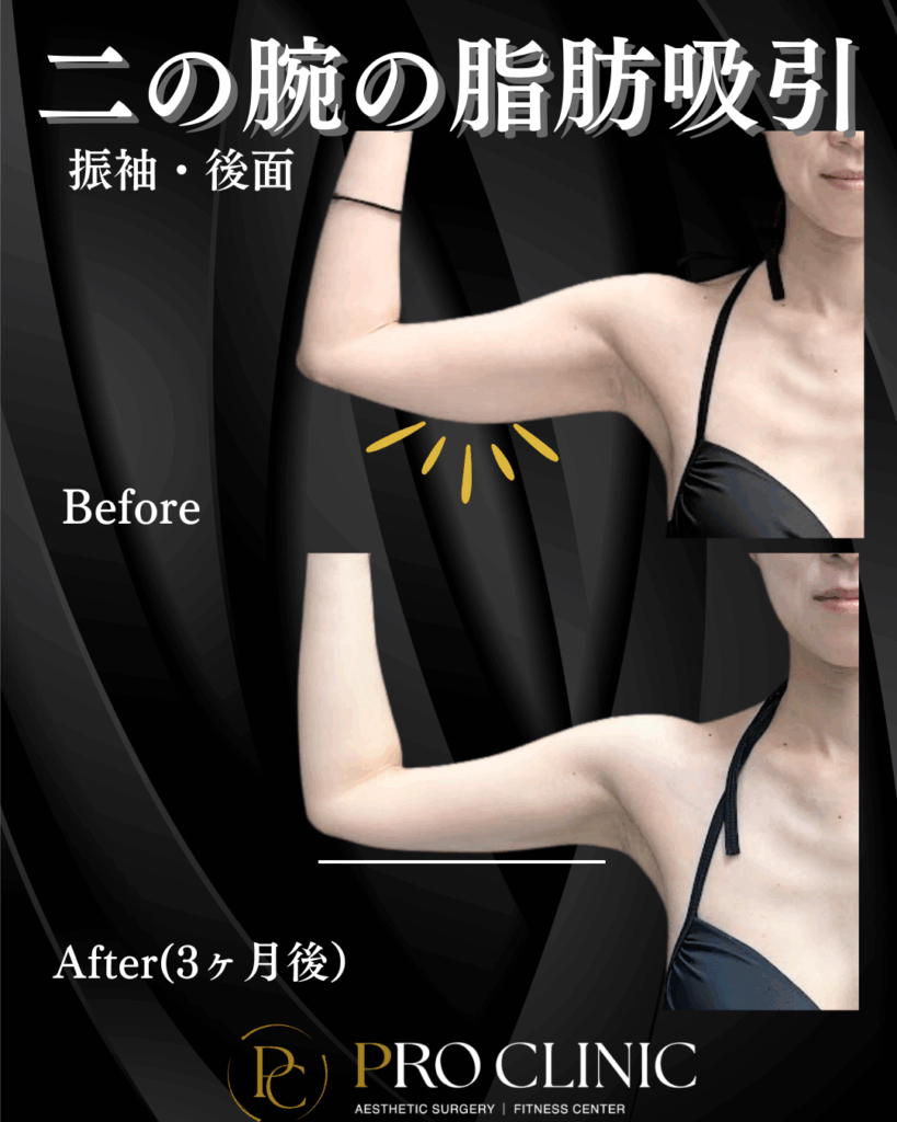 プロクリニック　二の腕の脂肪吸引　脂肪吸引