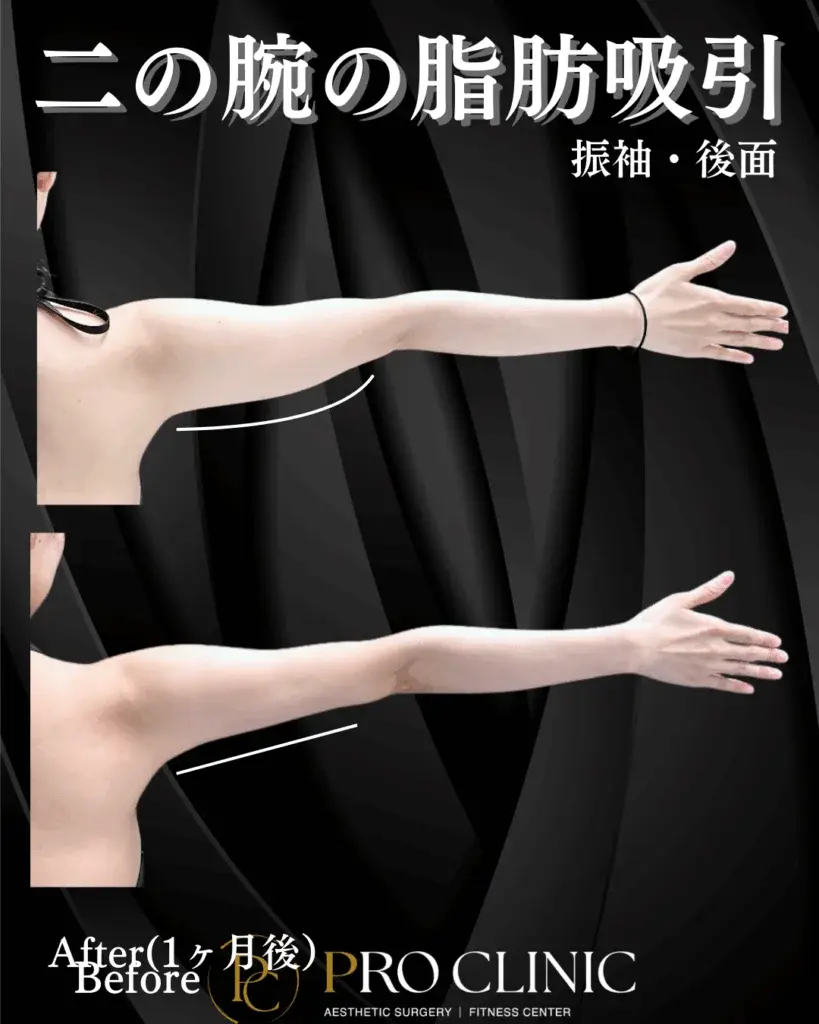 プロクリニック　二の腕の脂肪吸引　脂肪吸引
