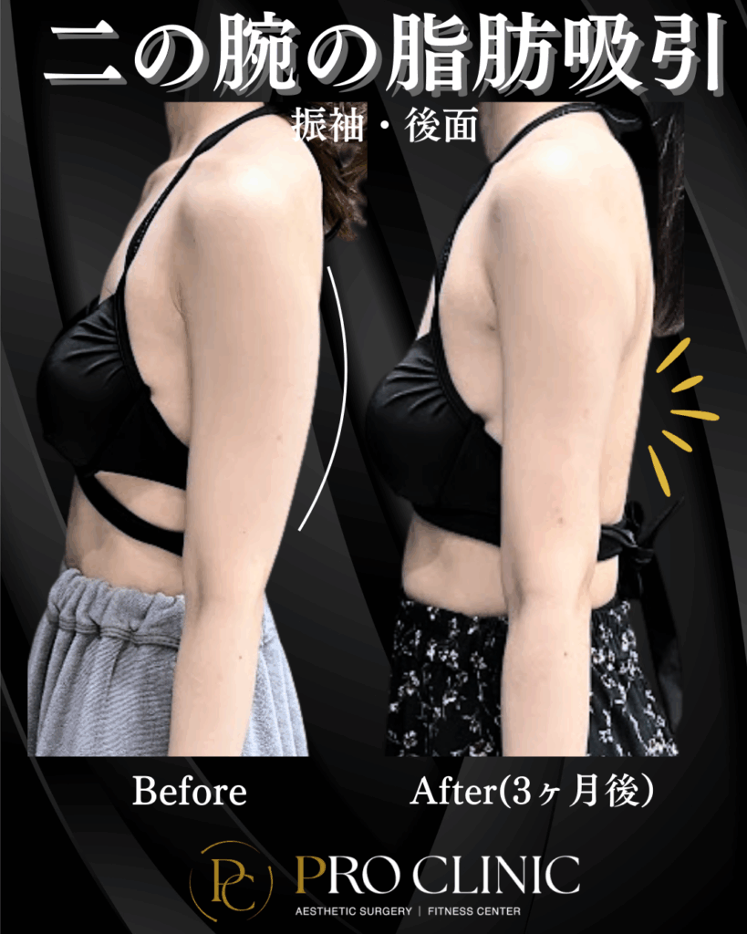 プロクリニック　二の腕の脂肪吸引　脂肪吸引