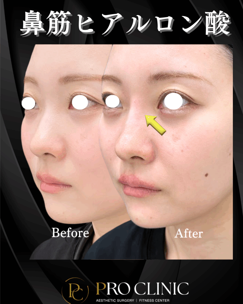 プロクリニック　ヒアルロン酸　鼻フル