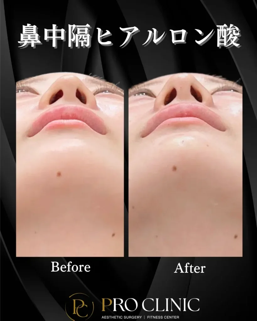 プロクリニック　ヒアルロン酸　鼻フル