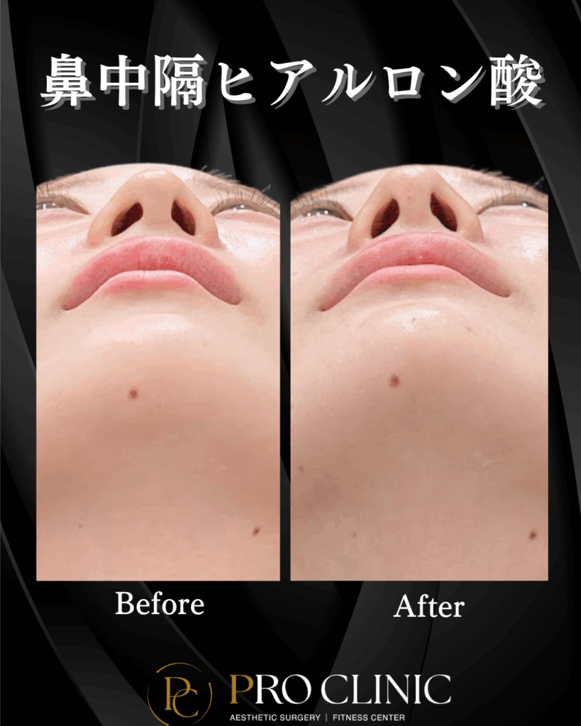 プロクリニック　ヒアルロン酸　鼻フル