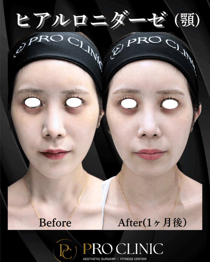 骨切り手術の準備として顎のヒアルロン酸をヒアルロニダーゼで溶かした正面の症例写真。施術1ヶ月後、長く太い顎が本来の自然なフェイスラインに戻り、正確な骨格診断ができる状態になっている。