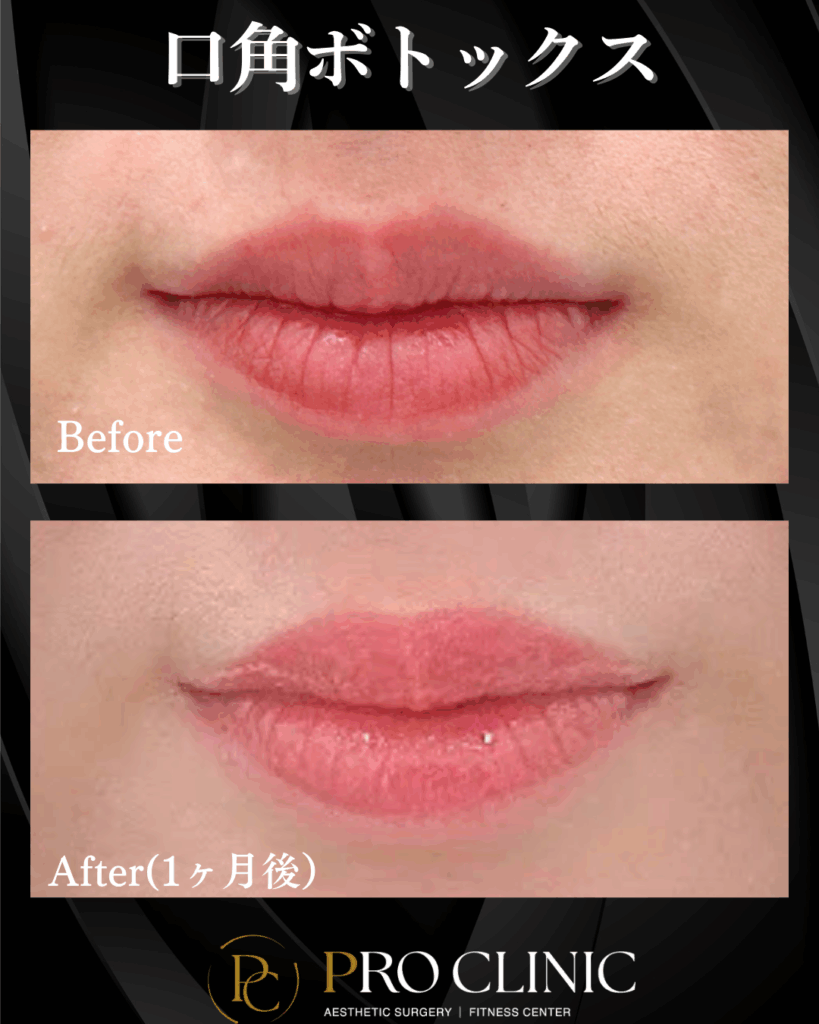 プロクリニック　口角挙上