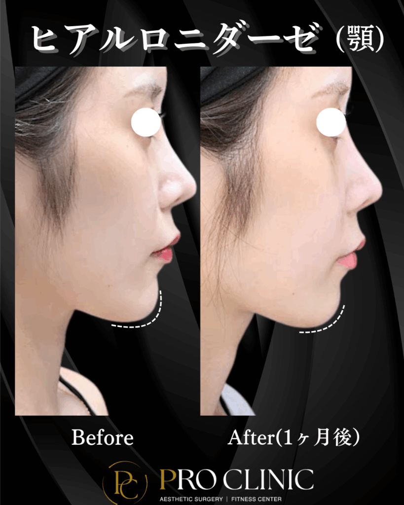 プロクリニックで行った顎のヒアルロニダーゼの症例写真。骨切り手術の前に、注入されていたヒアルロン酸を溶かした横顔のビフォーアフター。不自然な突出が消え、手術のカウンセリングに向け本来のEラインに戻っている。