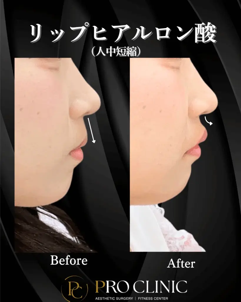 プロクリニック ヒアルロン酸 リップ
