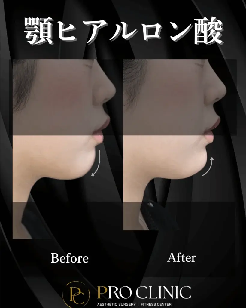 プロクリニック ヒアルロン酸 顎