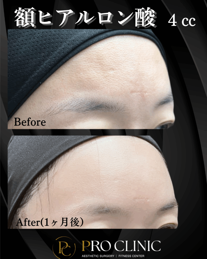 プロクリニック 額ヒアルロン酸 4cc 注入前と1ヶ月後の正面比較。おでこの凹凸が改善され、滑らかになった状態を示す。