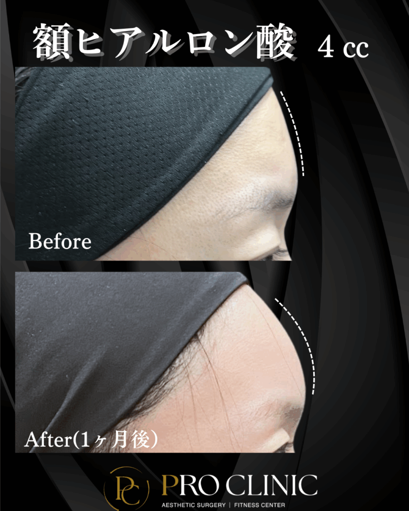 プロクリニック 額ヒアルロン酸 4cc 注入前と1ヶ月後の正面比較。おでこの凹凸が改善され、滑らかになった状態を示す。