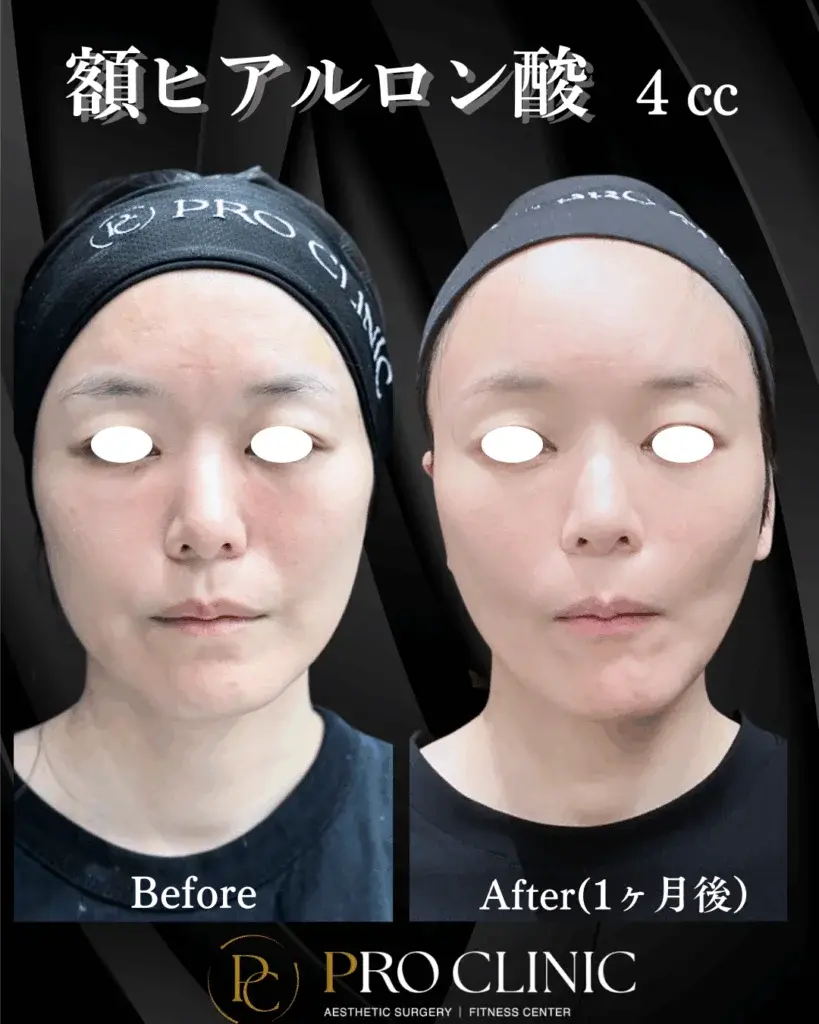 プロクリニック 額ヒアルロン酸 4cc 注入前と1ヶ月後の正面比較。おでこの凹凸が改善され、滑らかになった状態を示す。