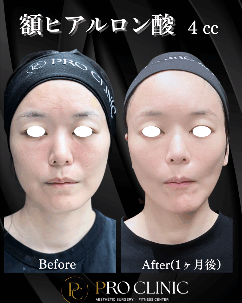 プロクリニック 額ヒアルロン酸 4cc 注入前と1ヶ月後の正面比較。おでこの凹凸が改善され、滑らかになった状態を示す。