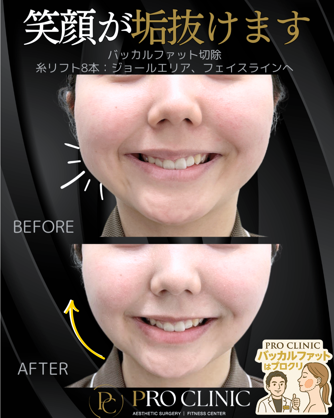 バッカルファット切除の症例画像（頬の内側の脂肪除去でフェイスラインをすっきり）