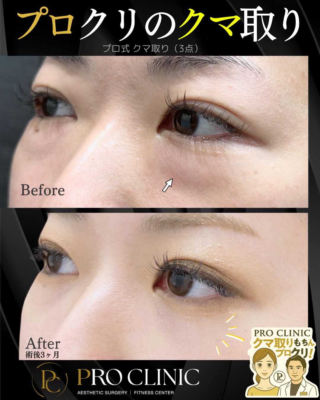 クマ取りの症例画像（目の下の膨らみや影を改善）