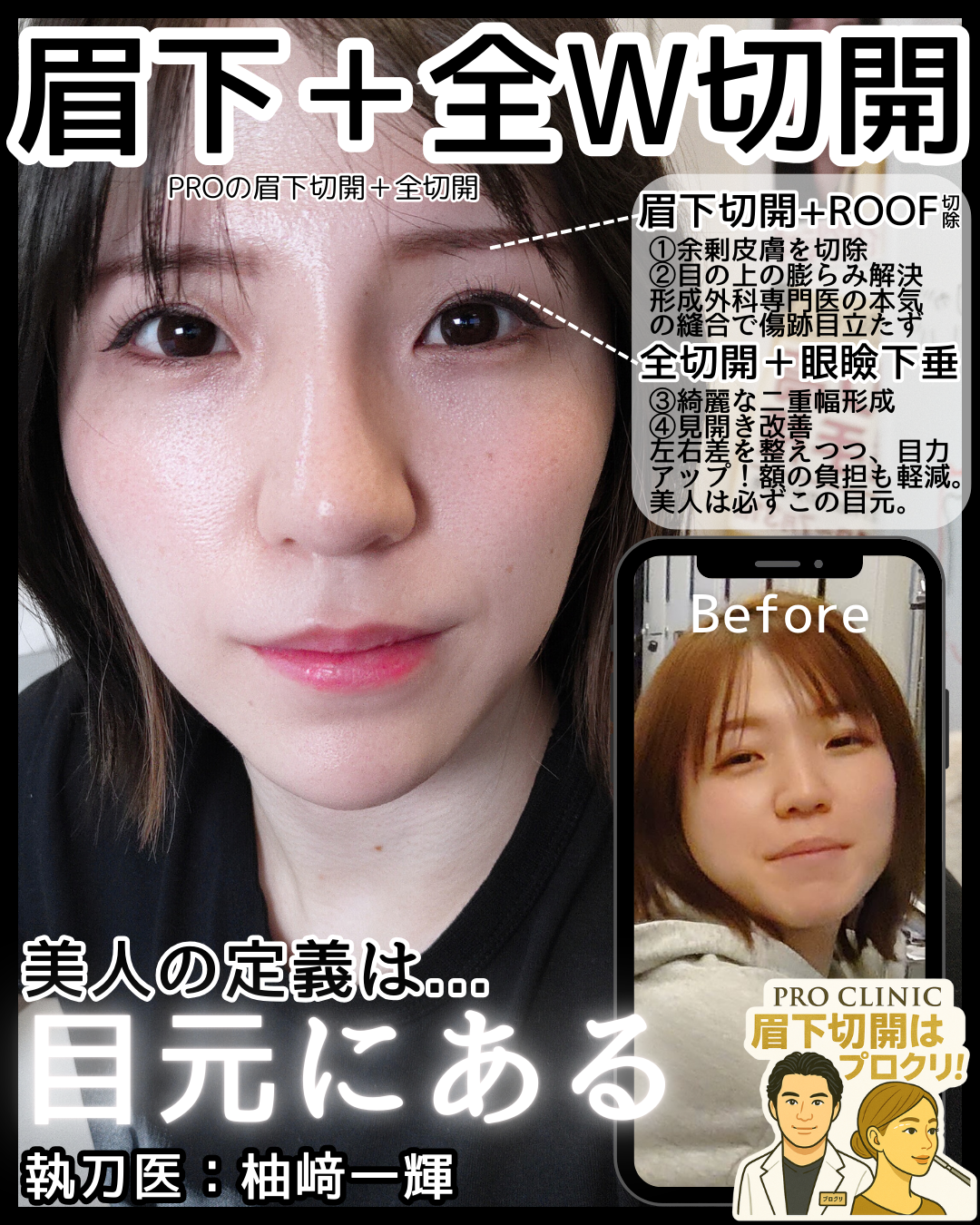 眉下切開の症例画像（上まぶたの被さりを改善）