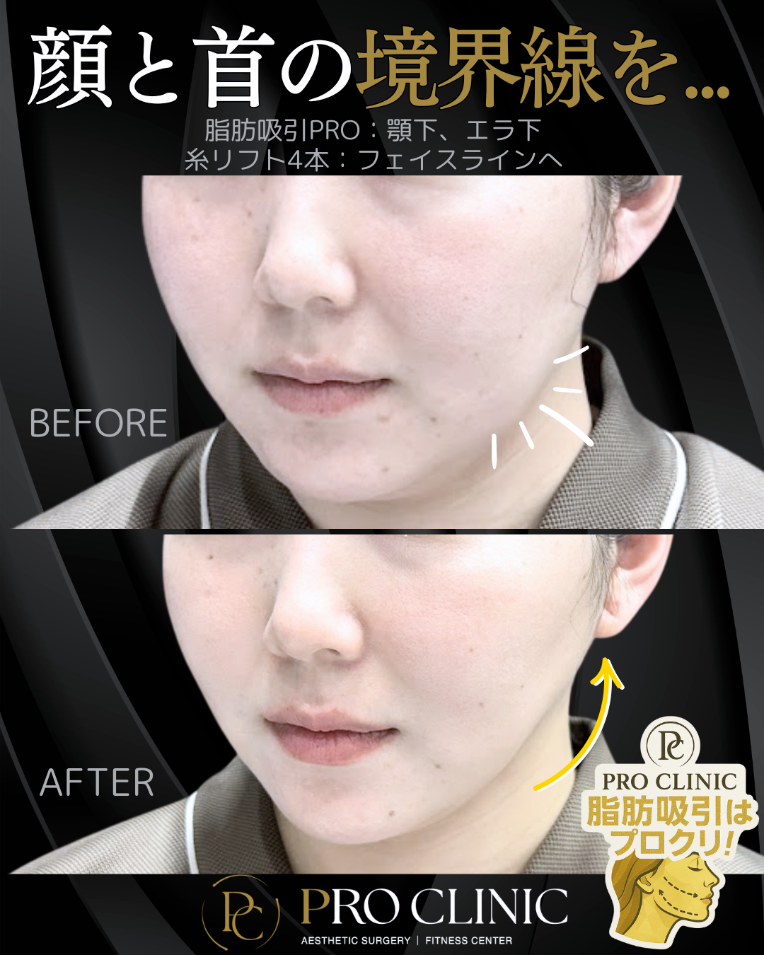 脂肪吸引の症例画像（顔や体の不要な脂肪をバランスよく除去）