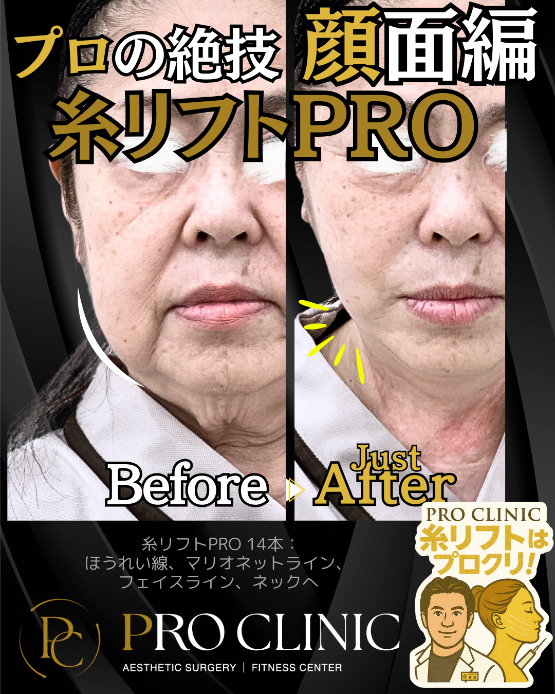 糸リフトの症例画像（口横や頬のゆるみを改善）