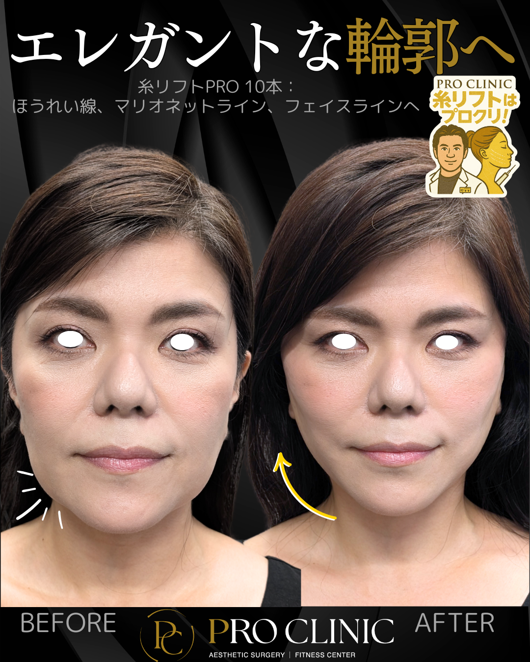 糸リフトの症例画像（たるみを引き上げ、輪郭を整える）