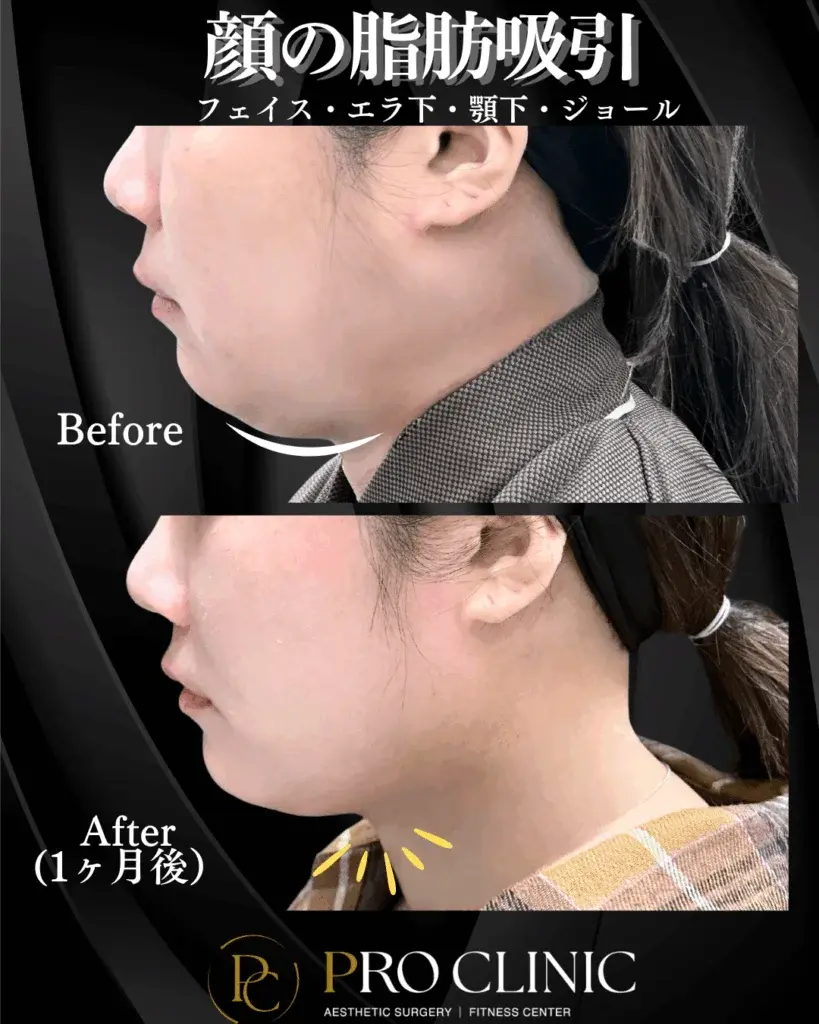 顔の脂肪吸引の症例写真（1ヶ月後）。プロクリニックにて施術し、厚かった二重顎の脂肪がすっきりとなくなり、フェイスラインが明確になっている。