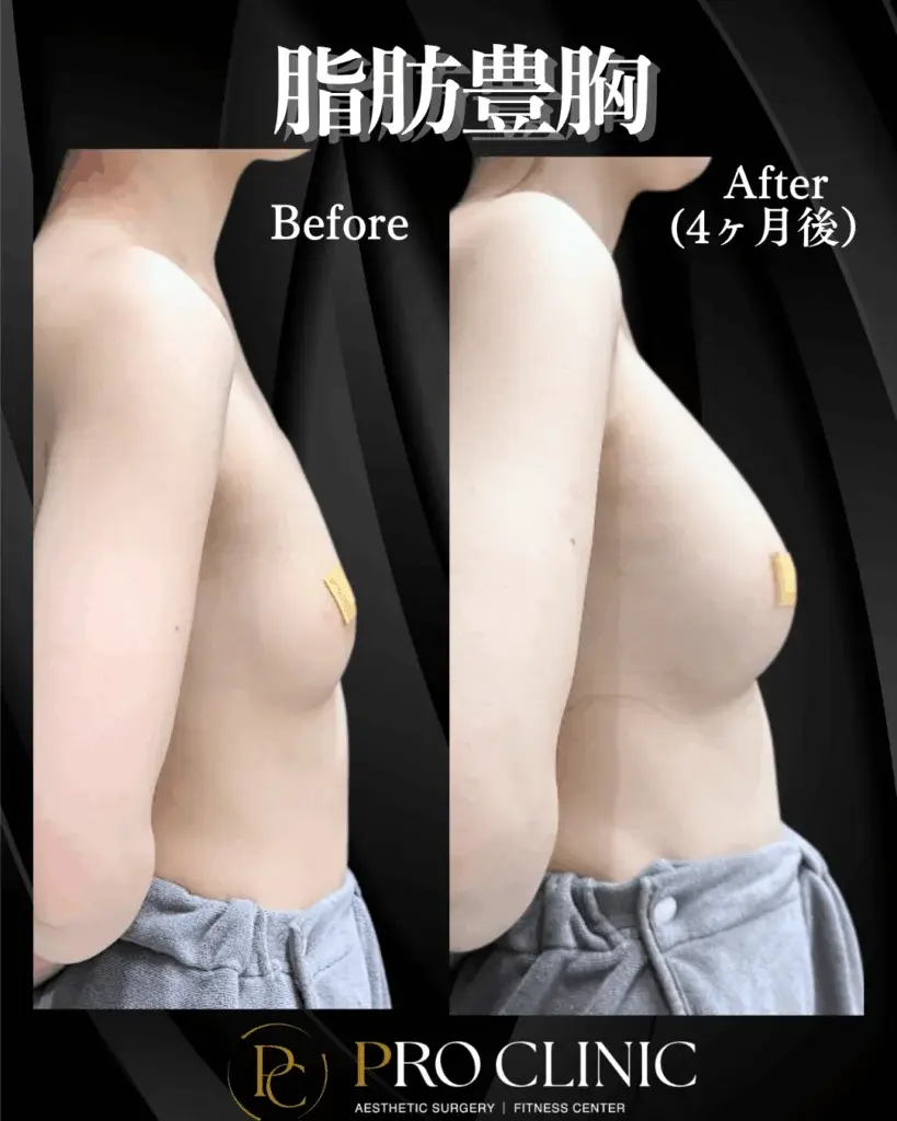プロクリニックの脂肪豊胸の症例写真。施術4ヶ月後の横顔で、平坦だった胸に自然な丸みと高さが出ているビフォーアフター。