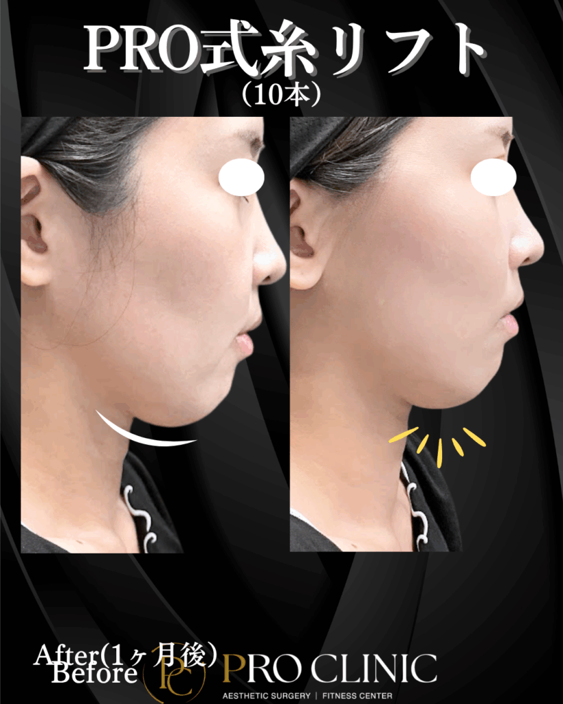 東京・銀座のプロクリニックで行った糸リフト（10本）の施術直後の症例写真。フェイスラインのもたつきが解消され、施術直後からVライン効果が出ている様子