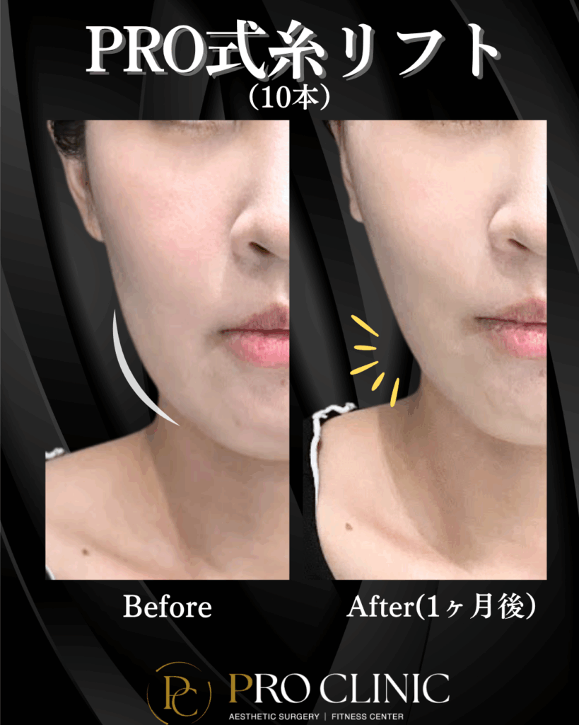 東京・銀座のプロクリニックで行った糸リフト（10本）の施術直後の症例写真。フェイスラインのもたつきが解消され、施術直後からVライン効果が出ている様子