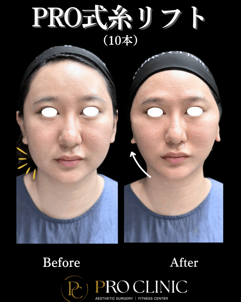 PRO式糸リフト10本を挿入した正面からの症例写真。施術後、頬全体のたるみがリフトアップされ、ほうれい線やマリオネットラインが薄くなり、若々しい印象になっている。