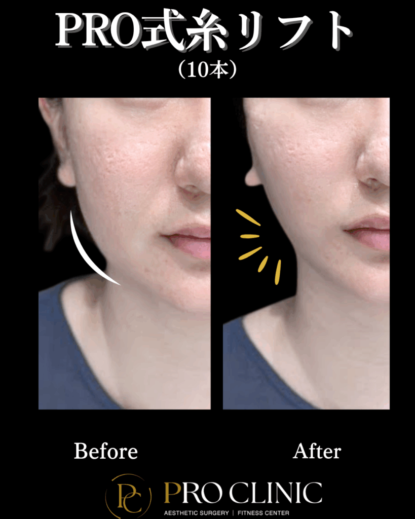 PRO式糸リフト10本を挿入した正面からの症例写真。施術後、頬全体のたるみがリフトアップされ、ほうれい線やマリオネットラインが薄くなり、若々しい印象になっている。
