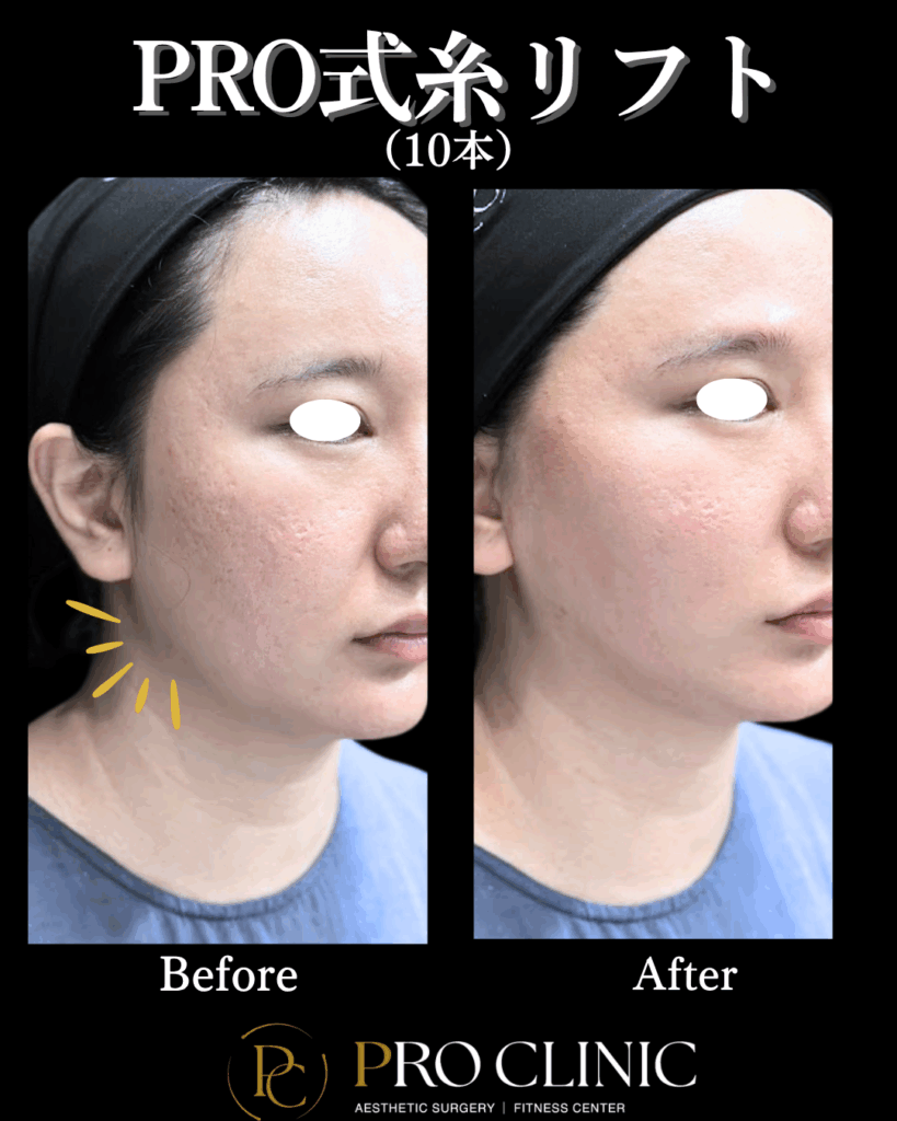 プロクリニックのPRO式糸リフトの症例写真。施術1ヶ月後の横顔で、もたついたフェイスラインと顎下のたるみが引き締まり、シャープなVラインになっているビフォーアフター。