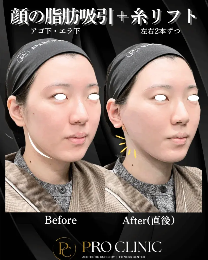 プロクリニックの「顔の脂肪吸引（アゴ下・エラ下）＋糸リフト（左右2本ずつ）」の併用施術の症例写真。施術直後の斜めからの比較で、もたついたフェイスラインが引き締まりVラインになっている。