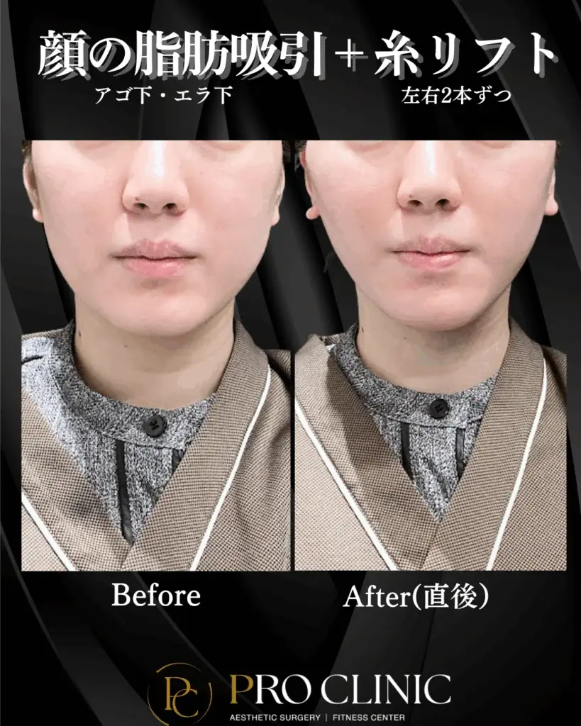 プロクリニックの「顔の脂肪吸引（アゴ下・エラ下）＋糸リフト（左右2本ずつ）」の併用施術の症例写真。施術直後の斜めからの比較で、もたついたフェイスラインが引き締まりVラインになっている。