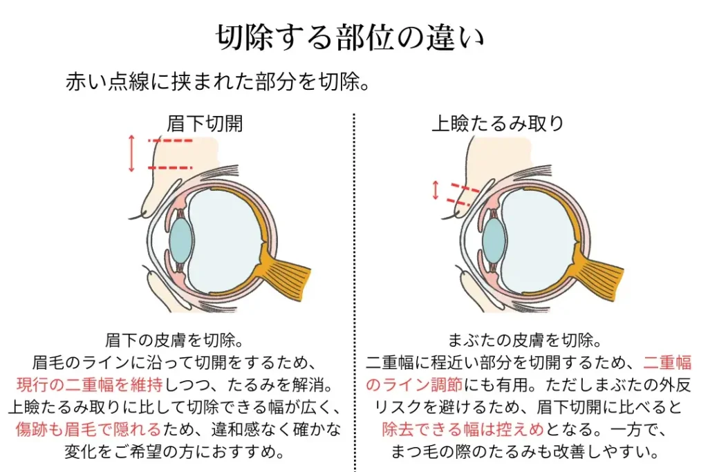 眉下切開と上瞼たるみ取り、どっちが正解？ - PRO CLINIC GIRLS｜銀座の小顔整形・美容外科・フェムケア《形成外科専門医監修》