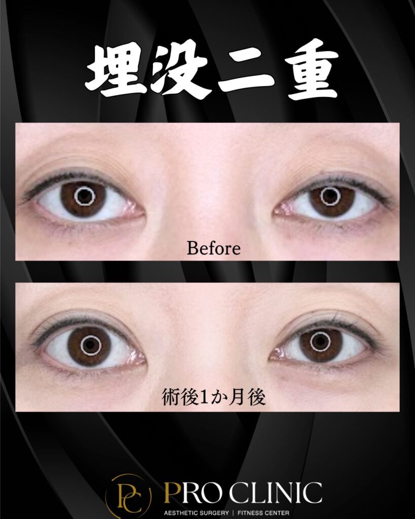 プロクリニックの埋没二重術の症例（１か月後・正面）。一重で目元に締まりがなかった術前（Before）と、術後1ヶ月で理想の二重幅が定着し、黒目が大きく見えるようになった正面からの目の変化。