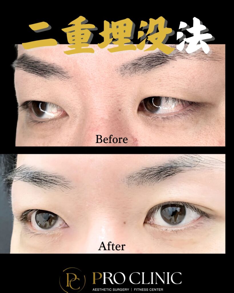 プロクリニックの二重埋没法による男性の目の症例。一重の術前（Before）と自然な二重になった術後（After）を比較。