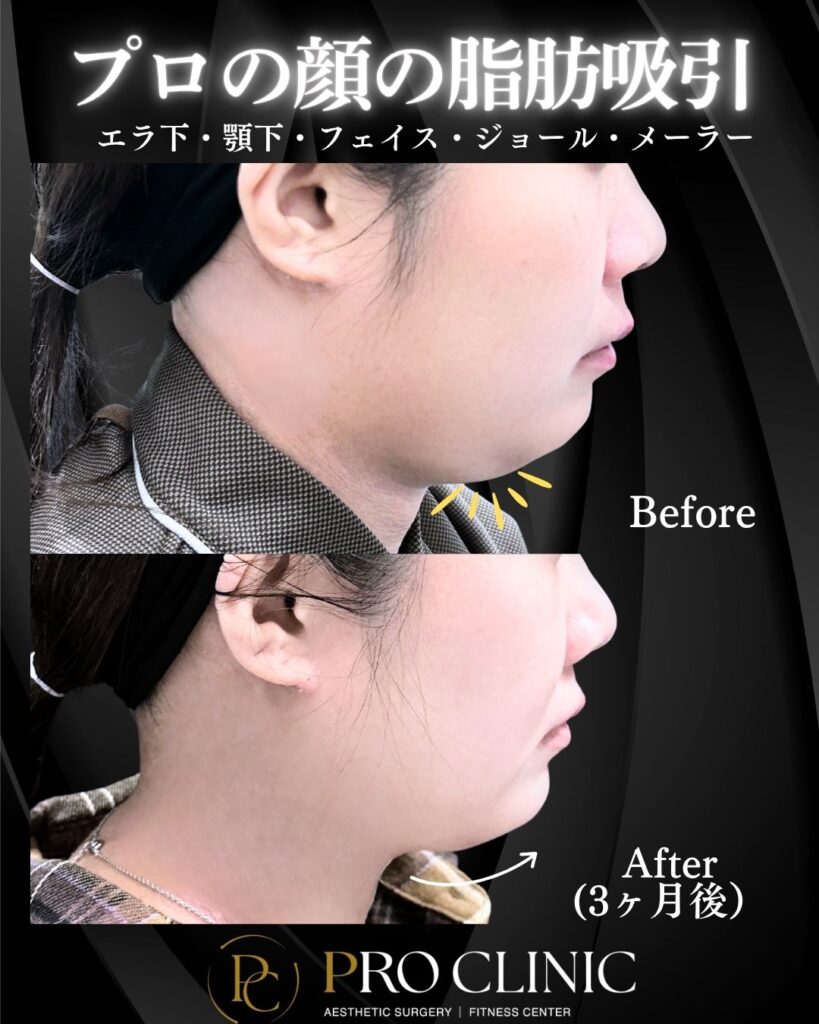 プロクリニックの顔の脂肪吸引の症例（3か月後・横）