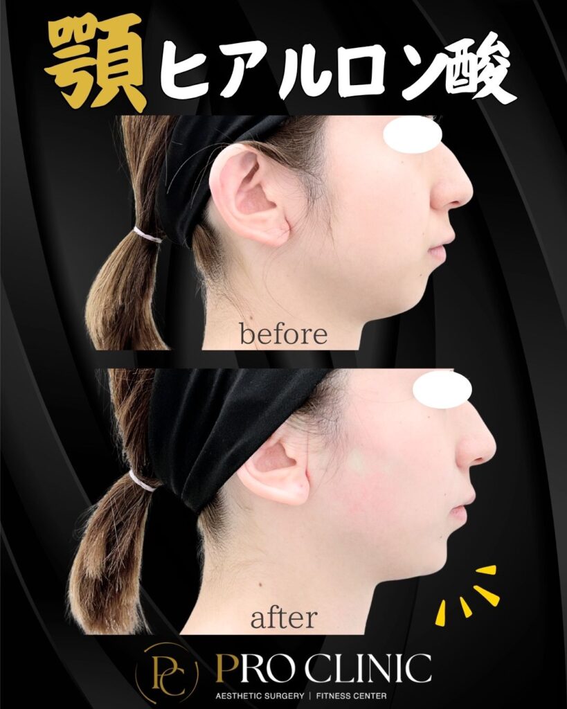 プロクリニックの顎ヒアルロン酸の症例（1か月後・横）