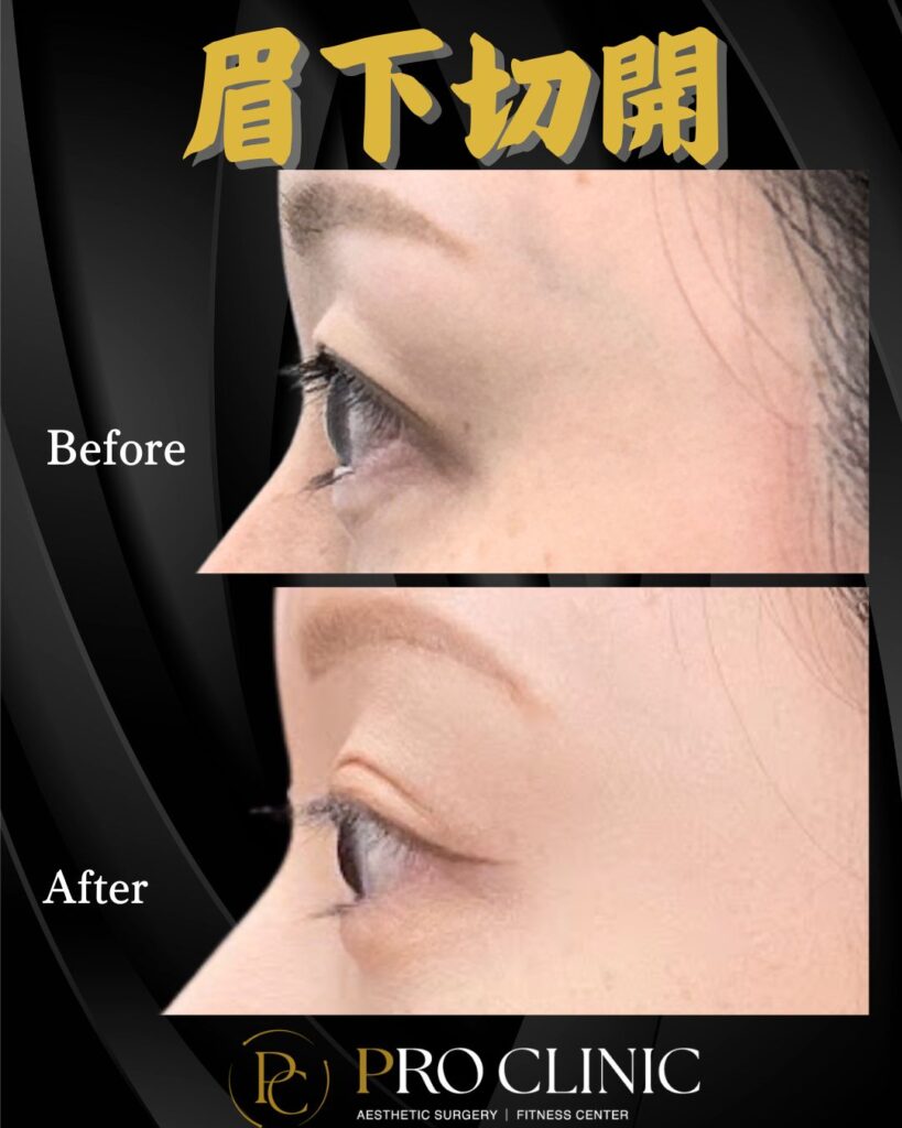 プロクリニックの眉下切開の症例（3か月後・横）