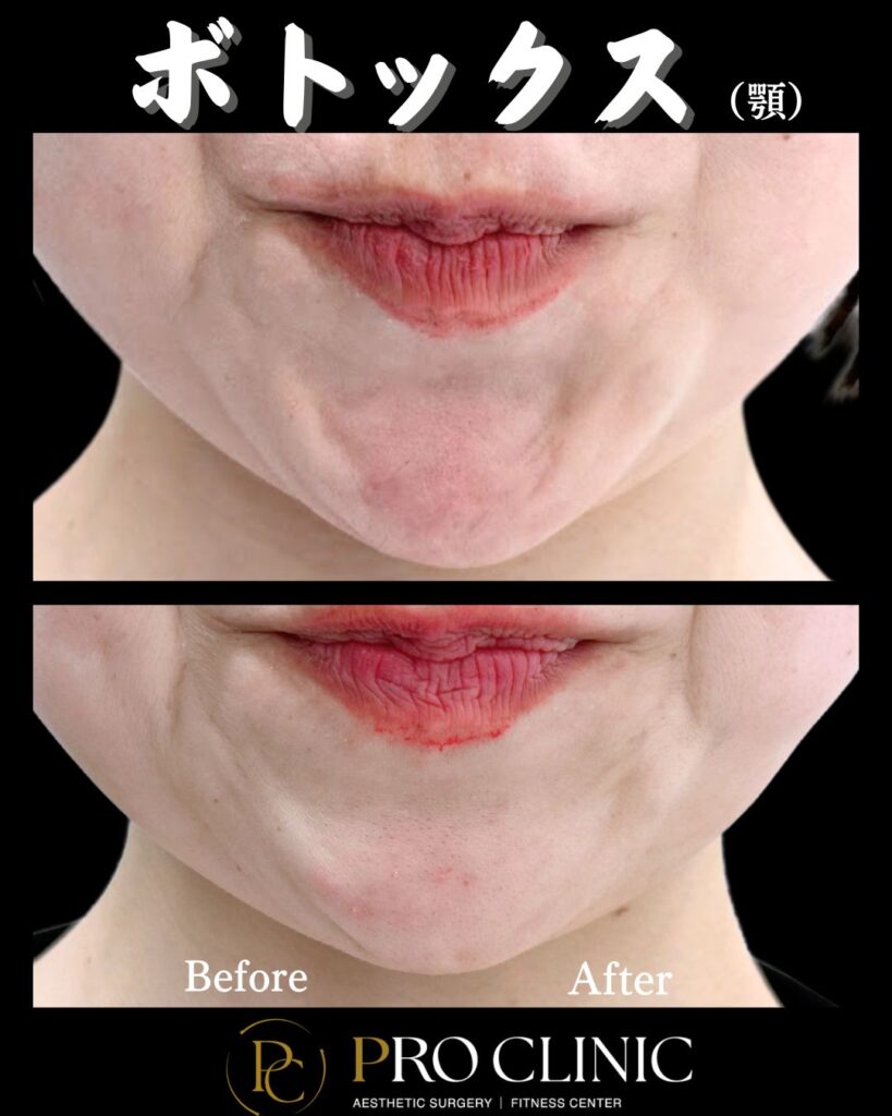 プロクリニックの顎ボトックスの症例（1か月後・正面）