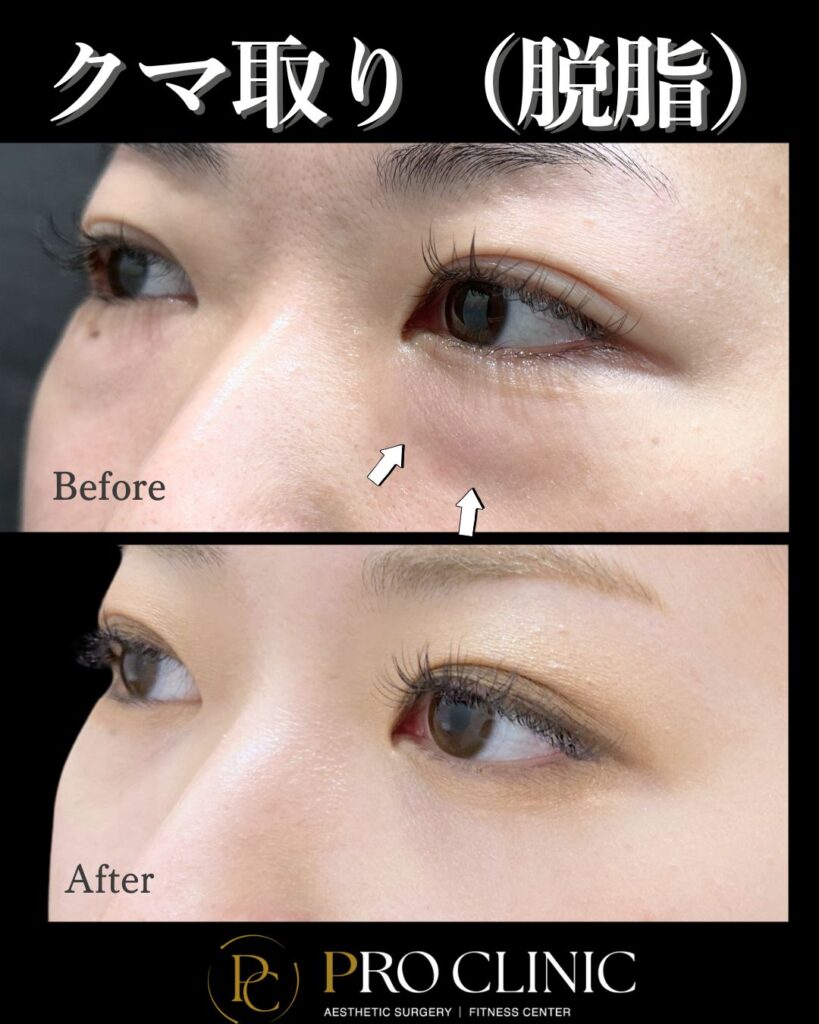 プロクリニックのクマ取り（脱脂）の症例（1ヶ月後・斜角）