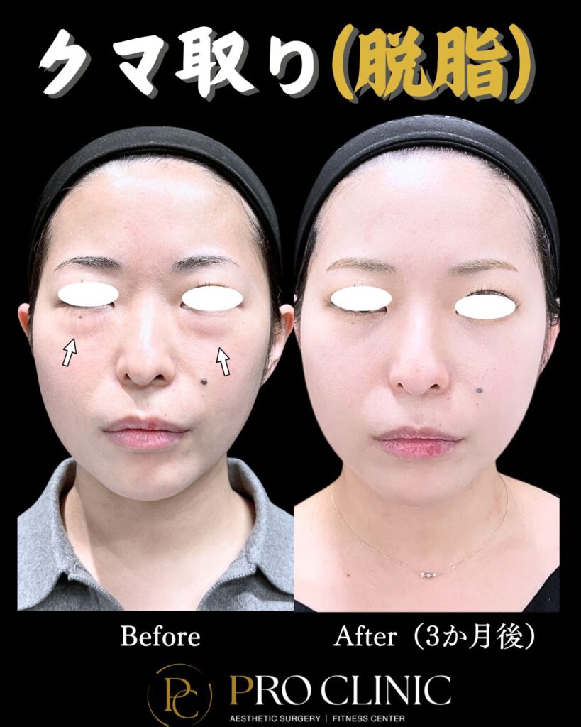 プロクリニックのクマ取り（脱脂）の症例（3か月後・正面）