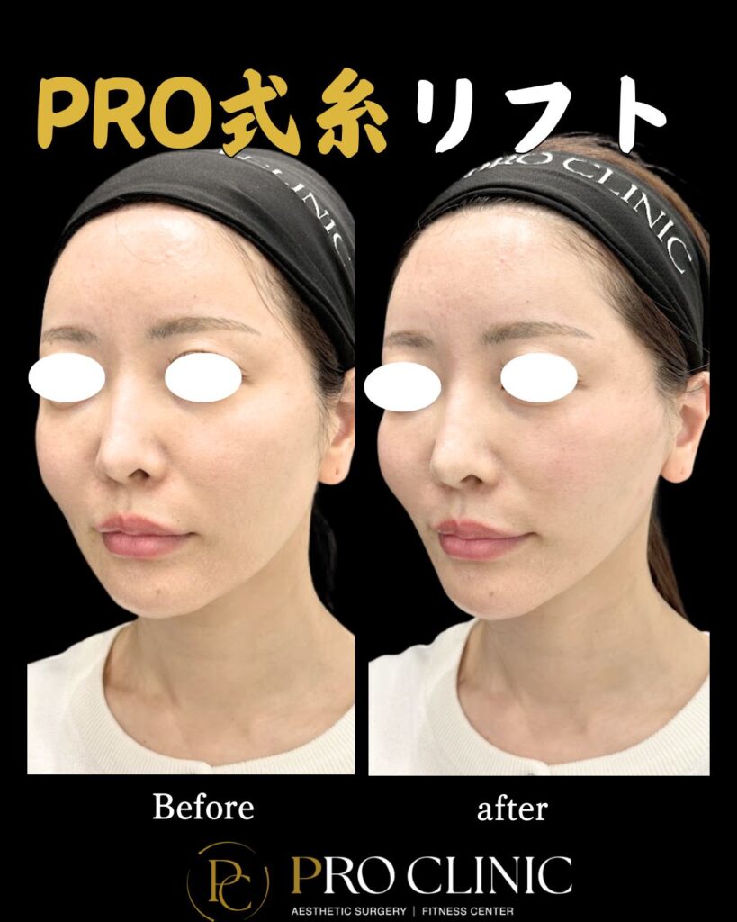 プロクリニックのPRO式糸リフトの症例（1か月後・斜角）
