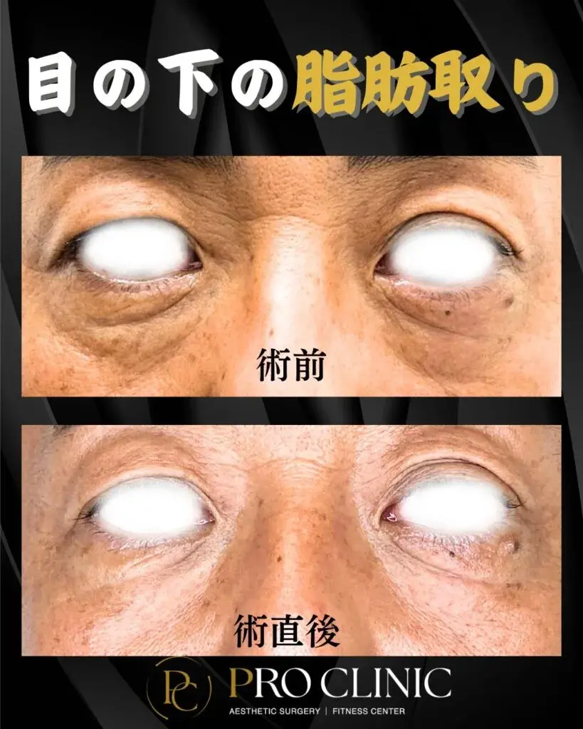 プロクリニックの目の下の脂肪取り（脱脂術）の症例（1か月後・正面）