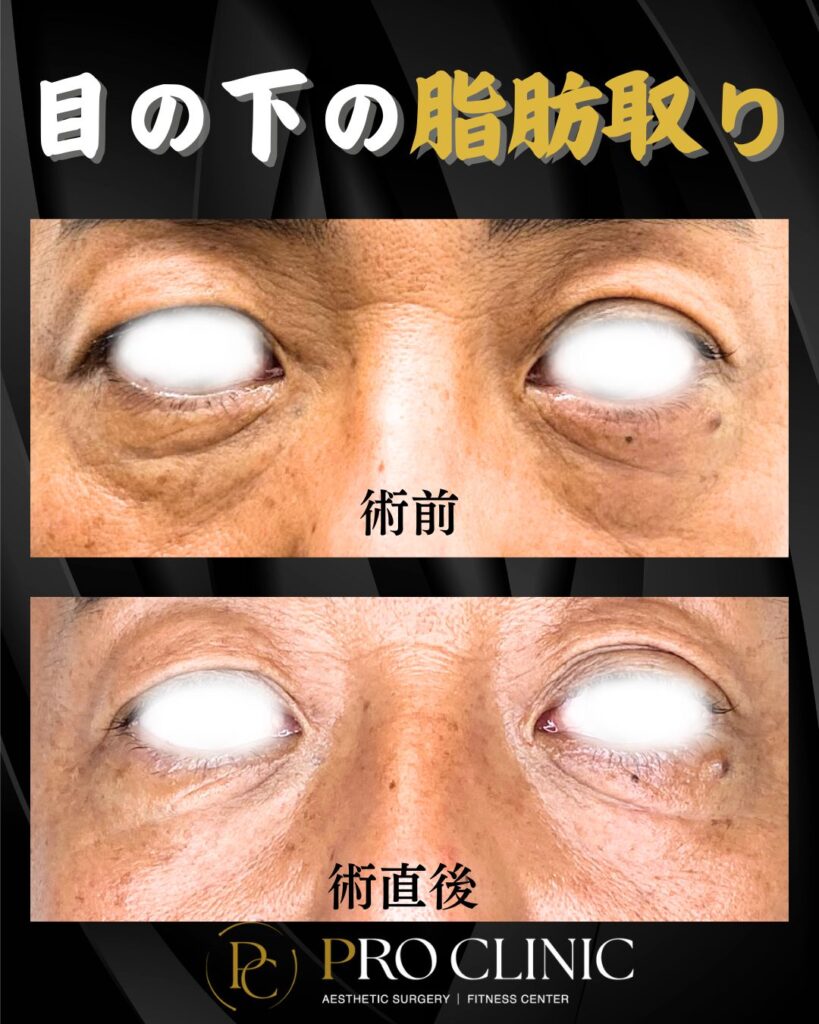 プロクリニックの目の下の脂肪取り（脱脂術）の症例（1か月後・正面）
