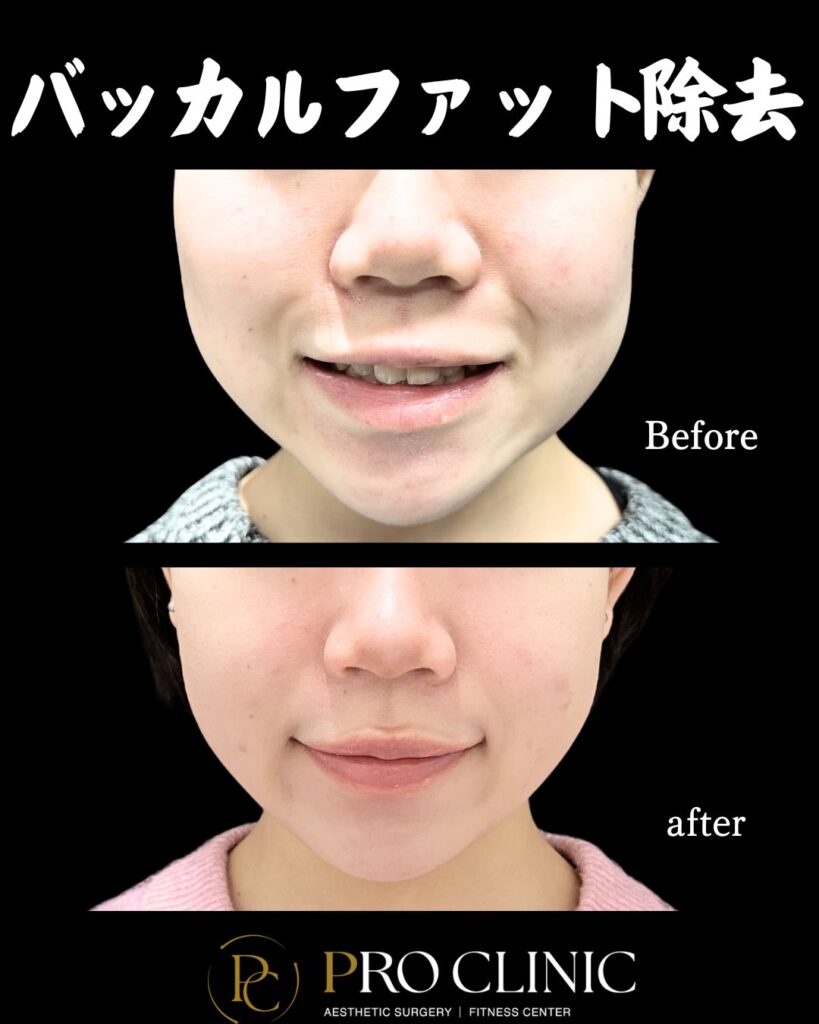 プロクリニックのバッカルファット除去の症例（1か月後・正面）