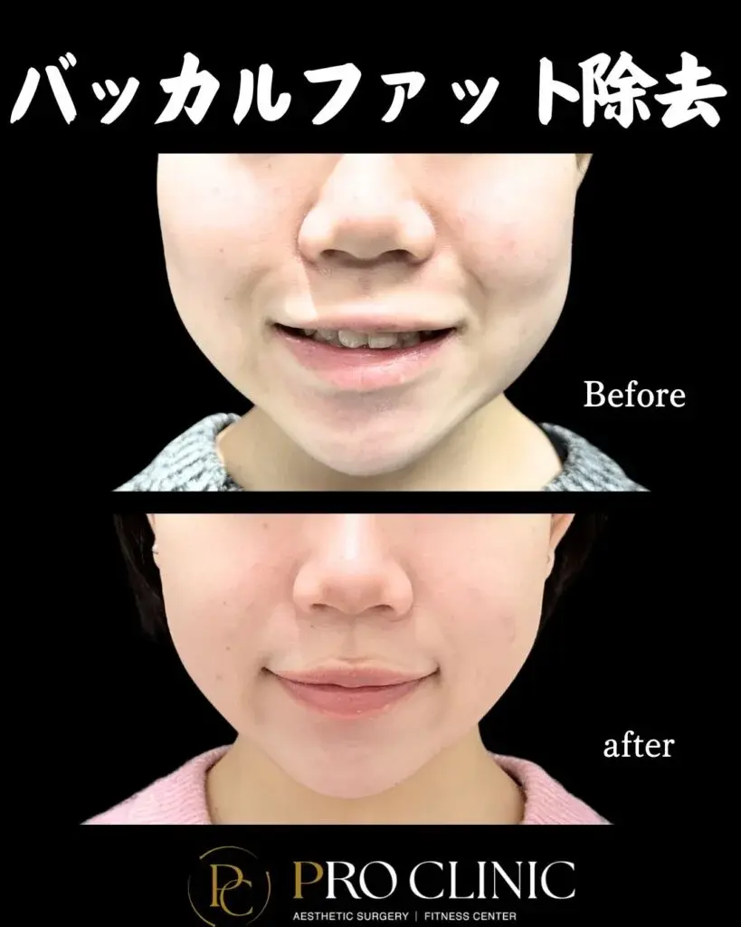 プロクリニックのバッカルファット除去の症例（1か月後・正面）