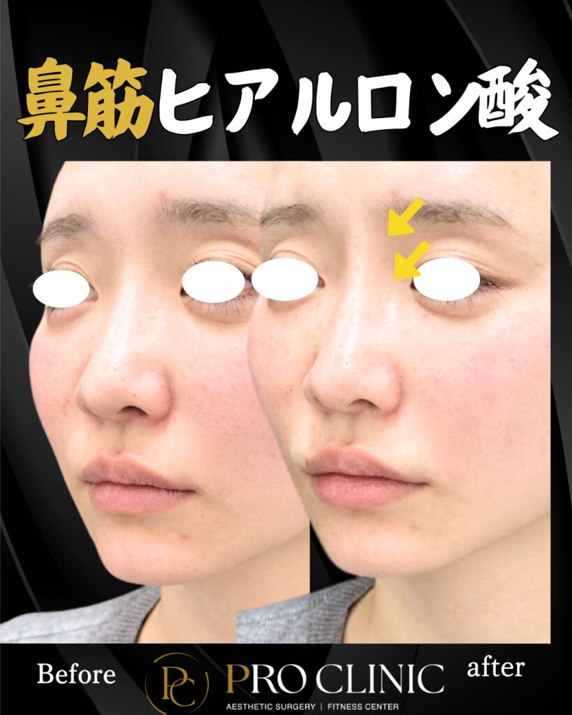 プロクリニックの鼻筋ヒアルロン酸注入の症例（１か月・斜角）
